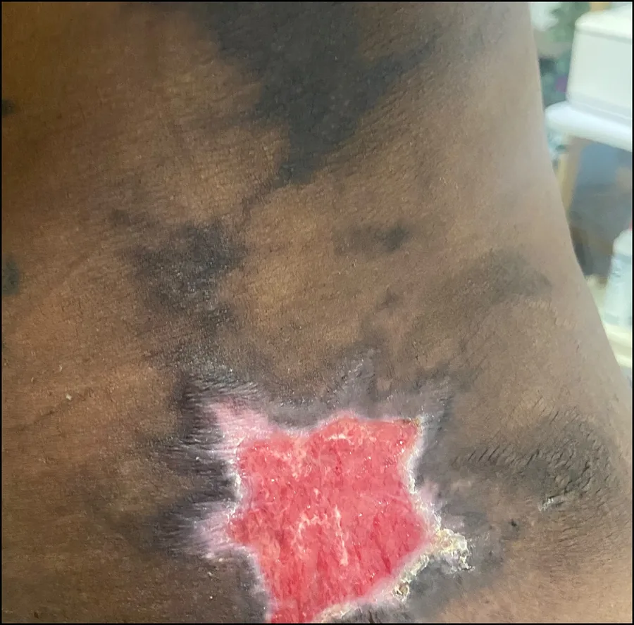 Primer plano de una herida en proceso de cicatrización sobre piel morena.