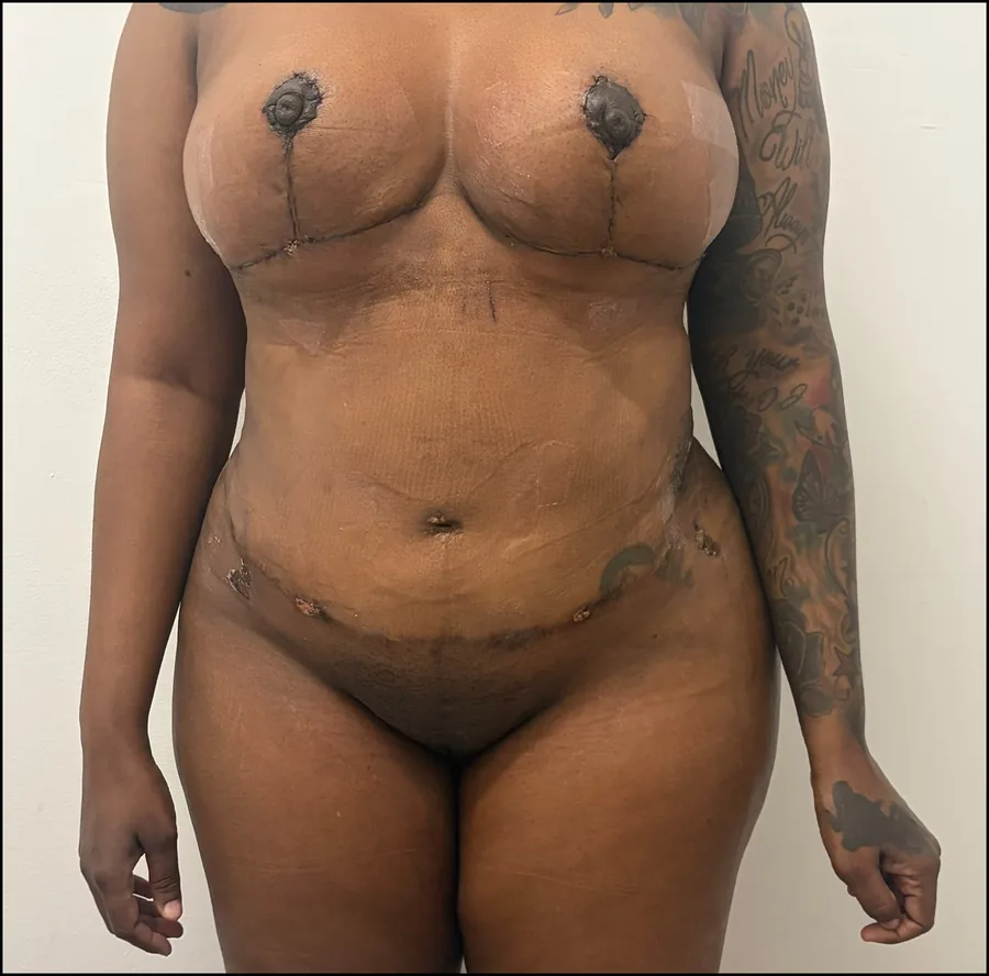 Torso de una paciente con cicatrices postoperatorias, vista frontal.